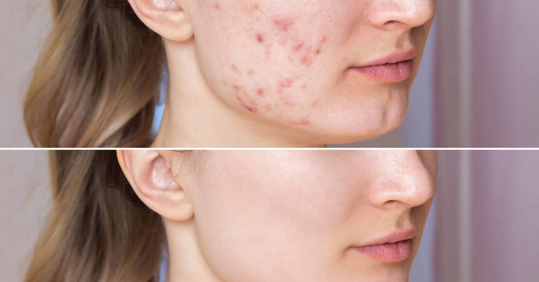 Endgame Acne Cream