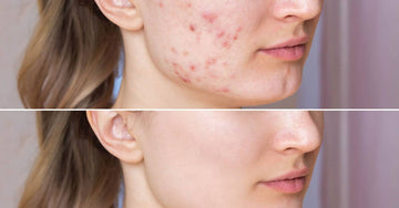 Endgame Acne Cream