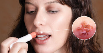 Fever Blister Prevention