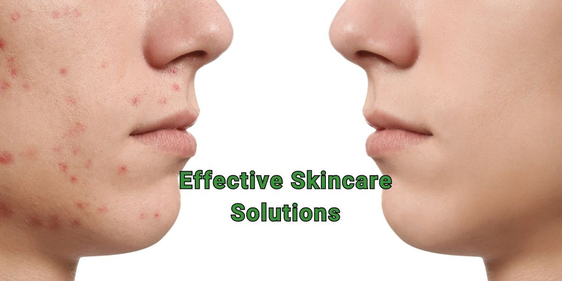 Effective Skincare Solutions: Salicylic Acid and Tretinoin for Acne, Hyperpigmentation, and Anti-Aging