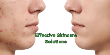 Effective Skincare Solutions: Salicylic Acid and Tretinoin for Acne, Hyperpigmentation, and Anti-Aging