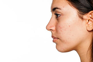 Compounded Solutions for Acne