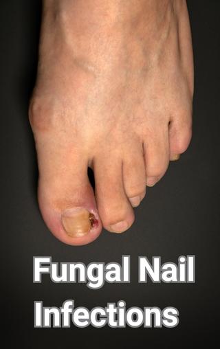 Nail Fungus — Fora Dermatology - General & Surgical Dermatology in  Mooresville, NC