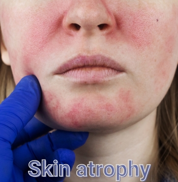 Skin atrophy