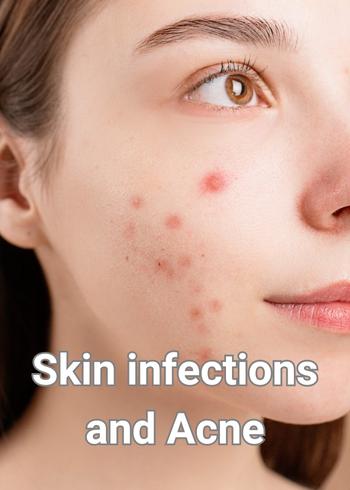 Skin infections and Acne 1
